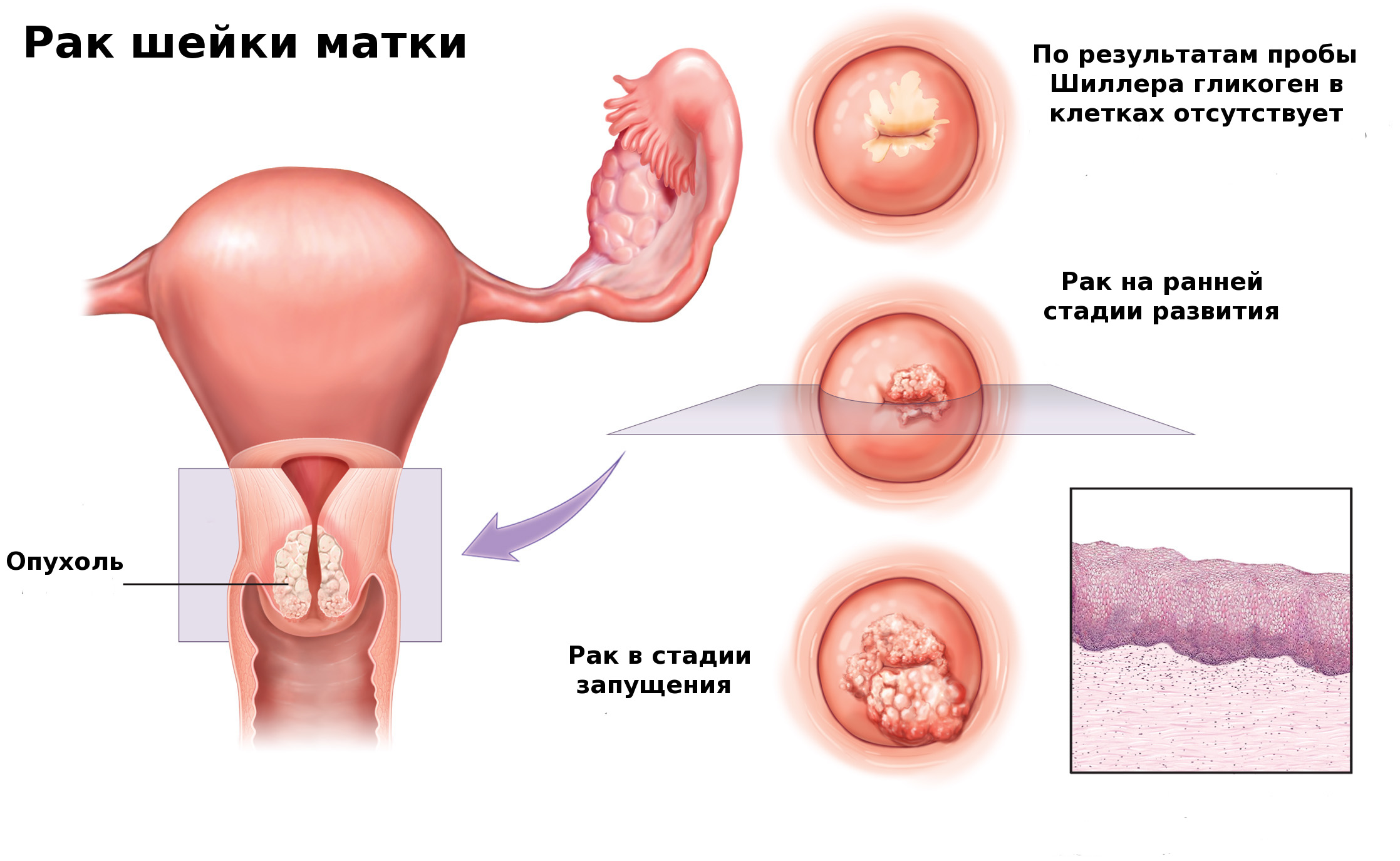 hpv rák mun az emberi bőr parazitái ellen